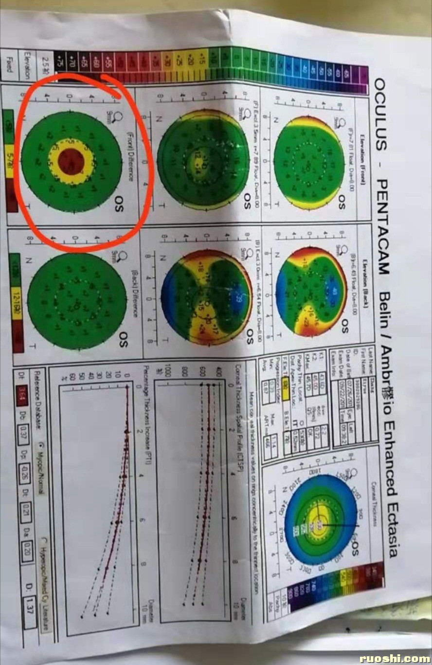 请汤医帮忙看看这个角膜地形图,谢谢